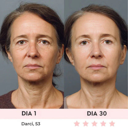 Lift Facial com HIFU – Tecnologia que Ativa o Colágeno e Rejuvenesce o Rosto