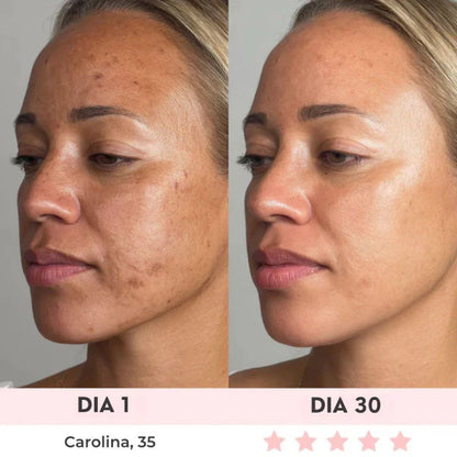 Lift Facial com HIFU – Tecnologia que Ativa o Colágeno e Rejuvenesce o Rosto