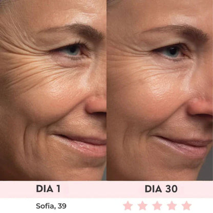 Lift Facial com HIFU – Tecnologia que Ativa o Colágeno e Rejuvenesce o Rosto
