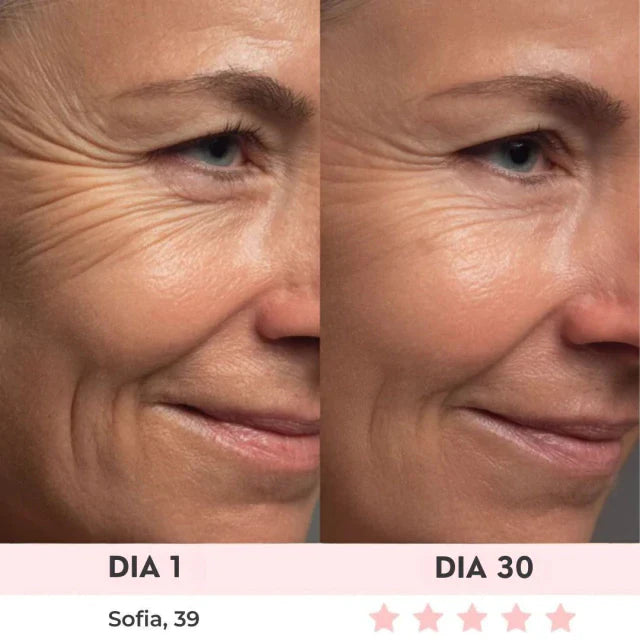 Lift Facial com HIFU – Tecnologia que Ativa o Colágeno e Rejuvenesce o Rosto